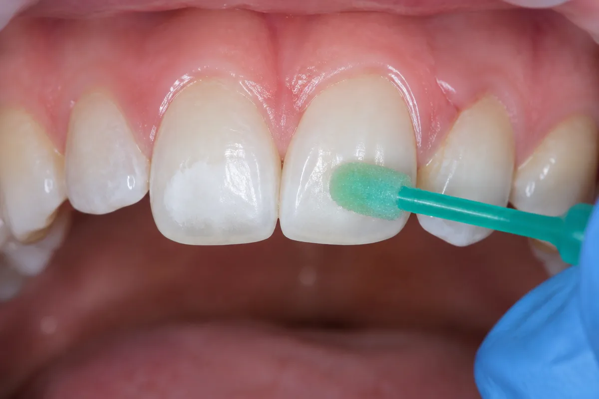 Icon Resin Infiltration