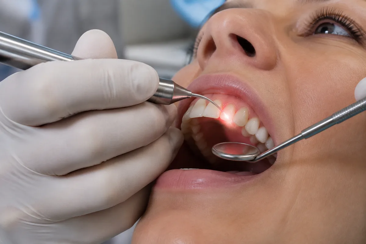 LANAP Laser Gum Treatment